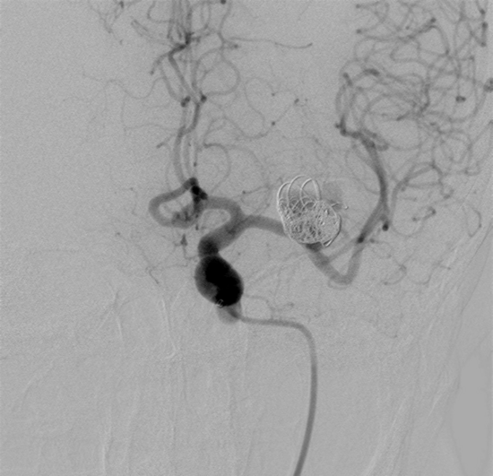 M1 left aneurysm