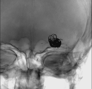 M1 left aneurysm