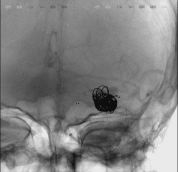 M1 left aneurysm
