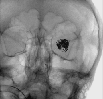 M1 left aneurysm