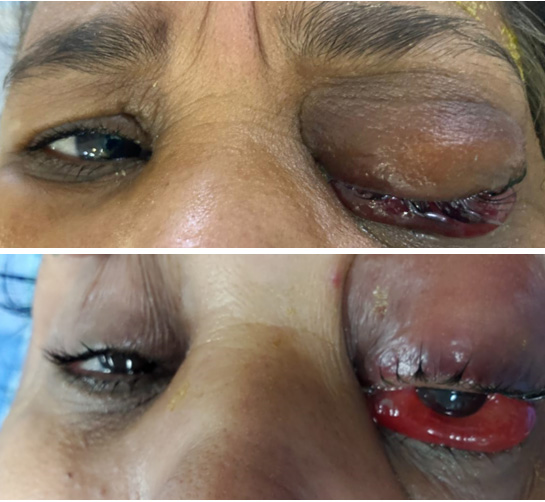 Management of complex CCF case