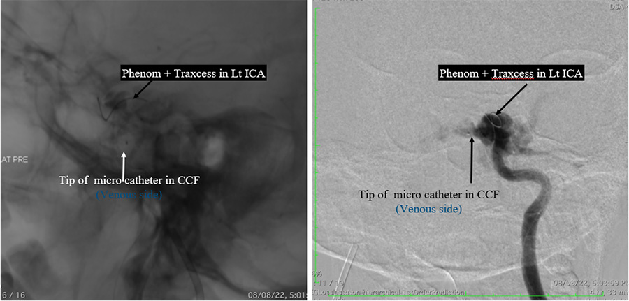 Management of complex CCF case