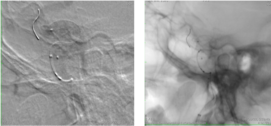 Management of complex CCF case