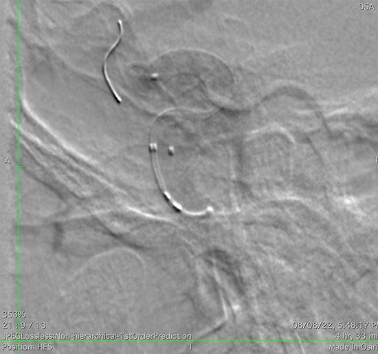 Management of complex CCF case