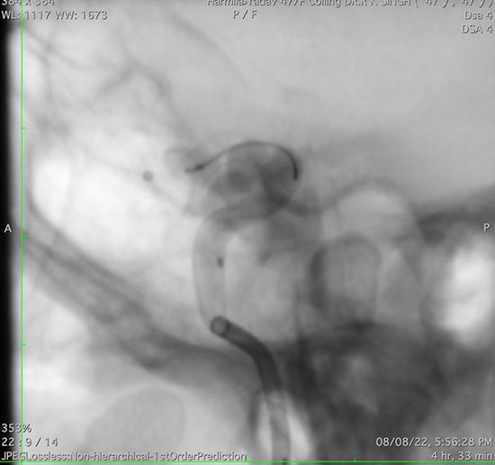 Management of complex CCF case