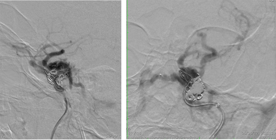 Management of complex CCF case
