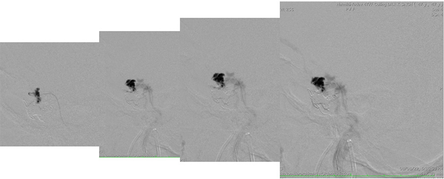 Management of complex CCF case