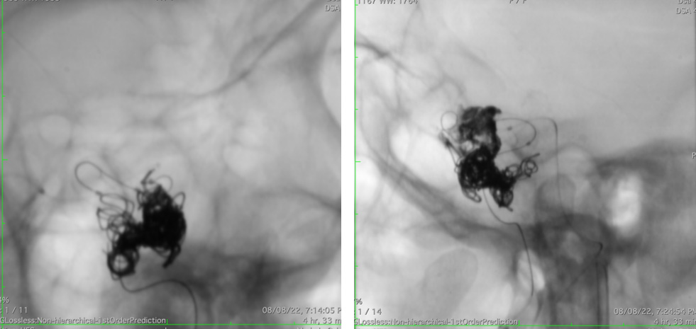 Management of complex CCF case