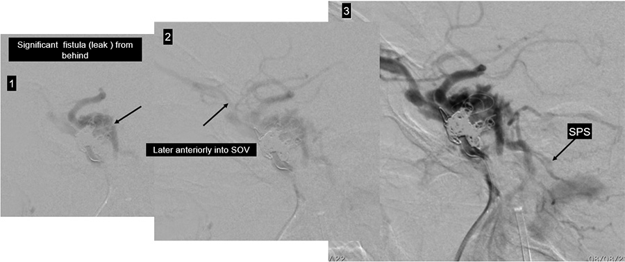 Management of complex CCF case