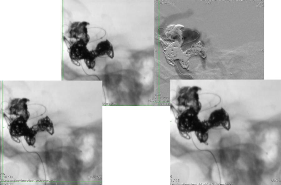 Management of complex CCF case