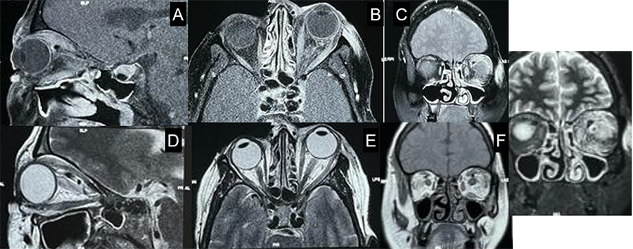 Management of complex CCF case