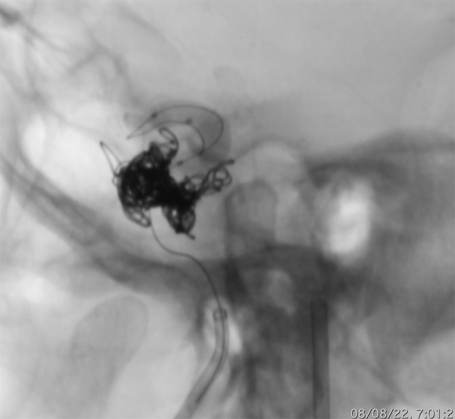 Management of complex CCF case
