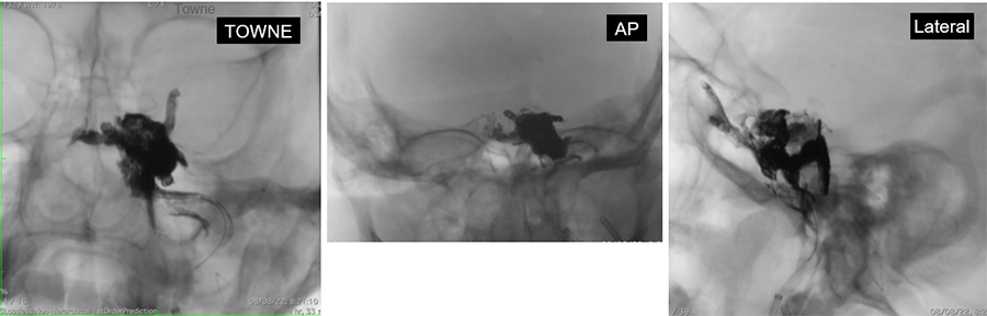Management of complex CCF case