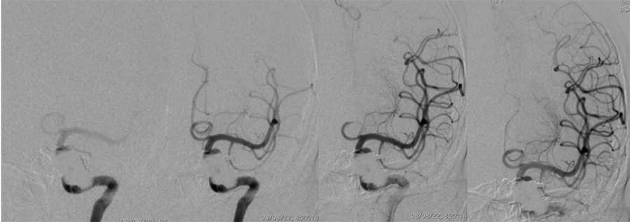 Management of complex CCF case