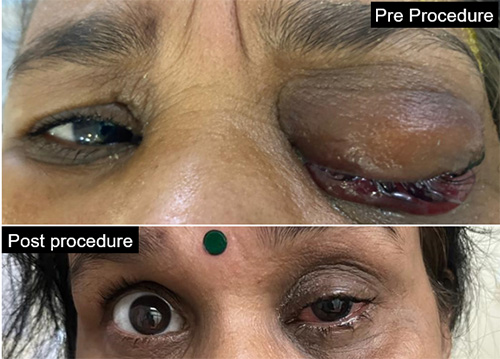 Management of complex CCF case