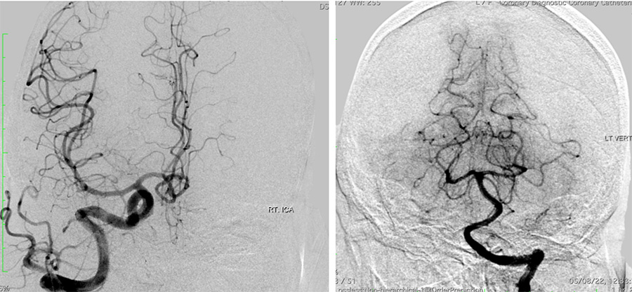 Management of complex CCF case