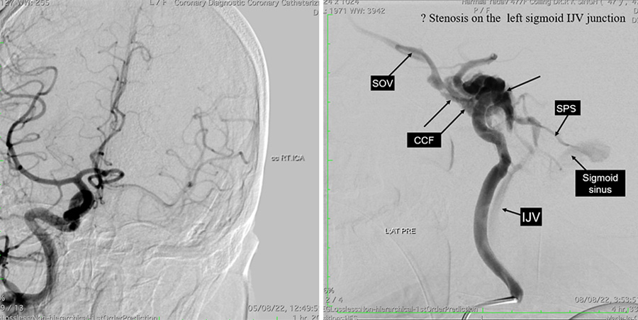 Management of complex CCF case