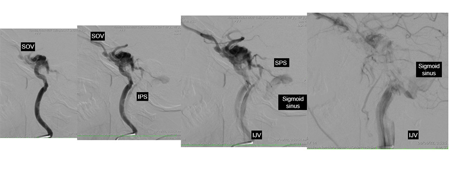 Management of complex CCF case