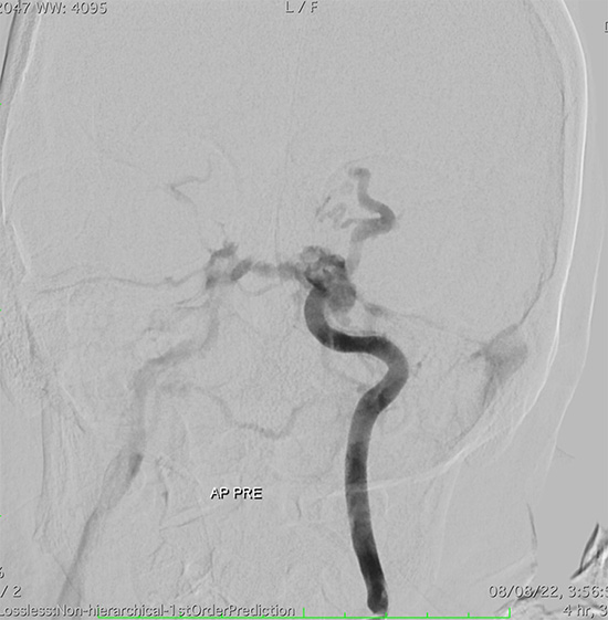 Management of complex CCF case