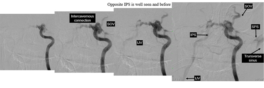 Management of complex CCF case