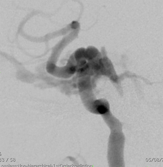Management of complex CCF case