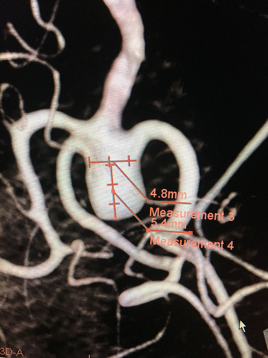 MCA aneurysm