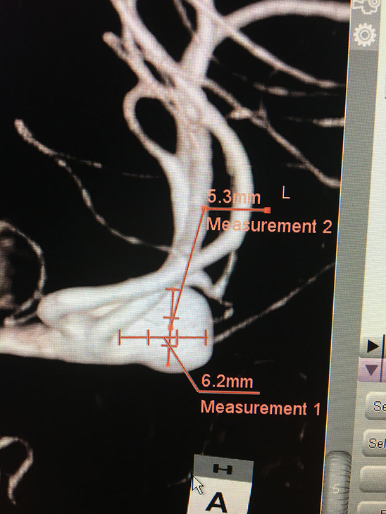 MCA aneurysm