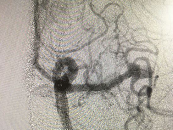 MCA aneurysm