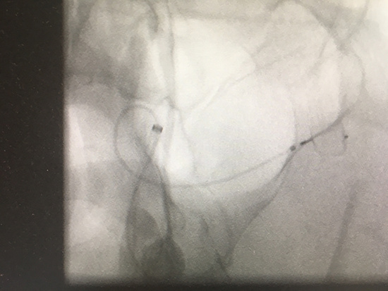 MCA aneurysm