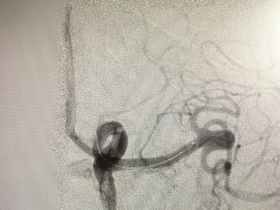 MCA aneurysm