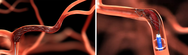 Mechanical Thrombectomy technique  