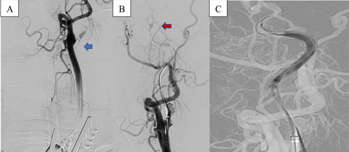 Microwire advanced into petrous segment of internal carotid artery