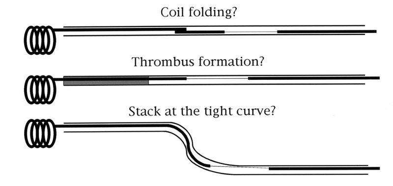 Monorail snare technique for retrieval of stretched Coil