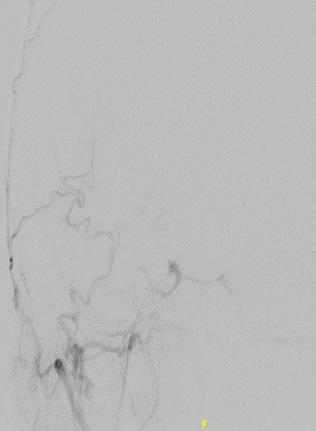 MRI brain was done which showed suspicion of carotid-cavernous fistula