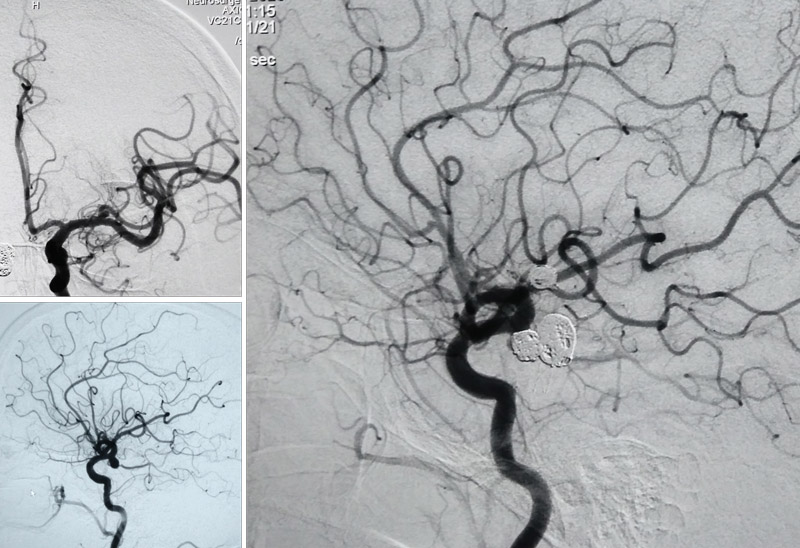MSA bifurcation aneurysms, ICA aneurysm & Follow up