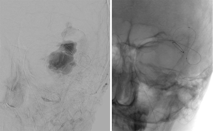 Multipouch Intraosseous DAVF Embolisation