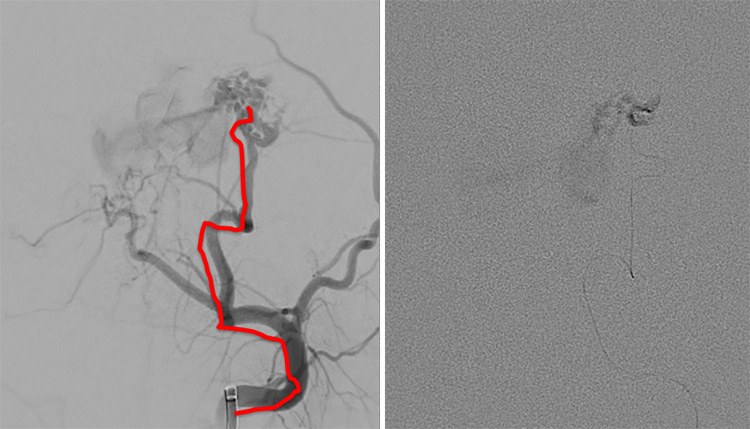 Multipouch Intraosseous DAVF Embolisation