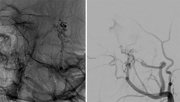 Multipouch Intraosseous DAVF Embolisation