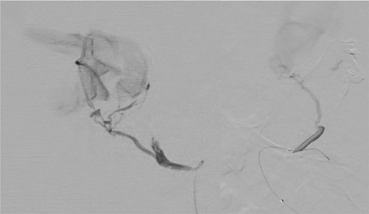 Multipouch Intraosseous DAVF Embolisation