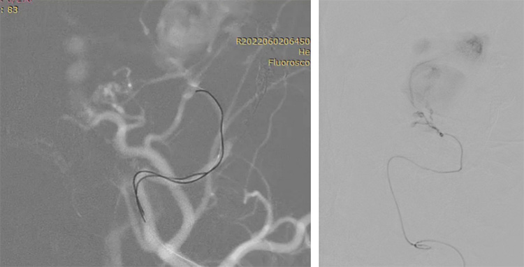 Multipouch Intraosseous DAVF Embolisation