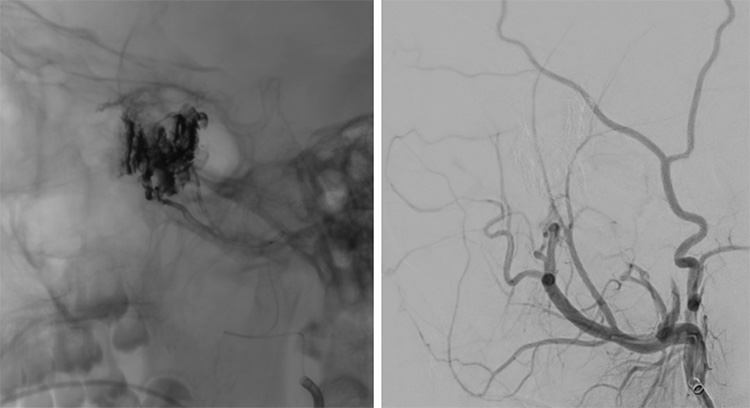 Multipouch Intraosseous DAVF Embolisation
