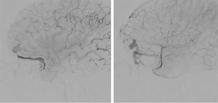 Multipouch Intraosseous DAVF Embolisation