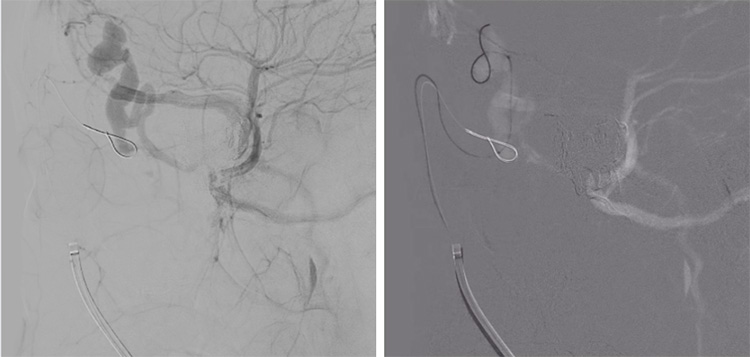 Multipouch Intraosseous DAVF Embolisation