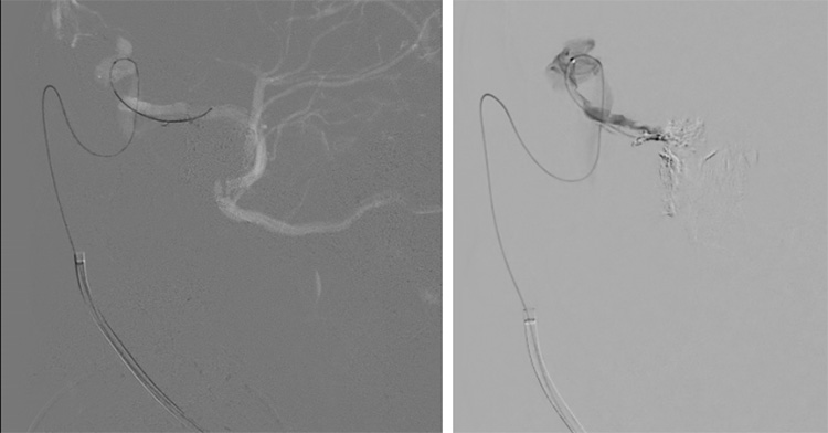 Multipouch Intraosseous DAVF Embolisation