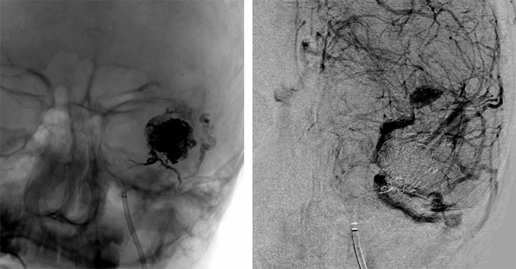 Multipouch Intraosseous DAVF Embolisation