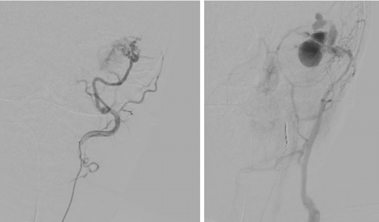 Multipouch Intraosseous DAVF Embolisation
