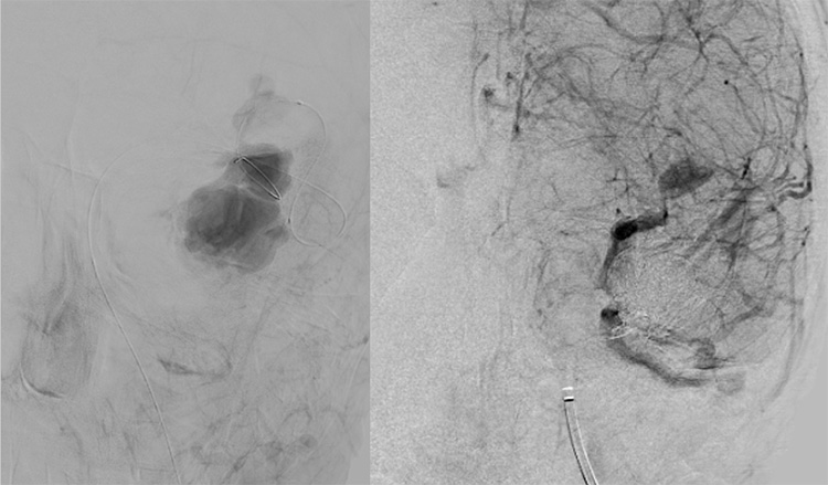 Multipouch Intraosseous DAVF Embolisation