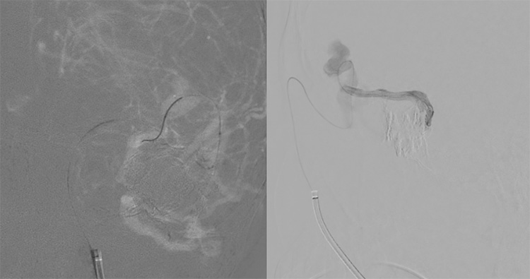 Multipouch Intraosseous DAVF Embolisation