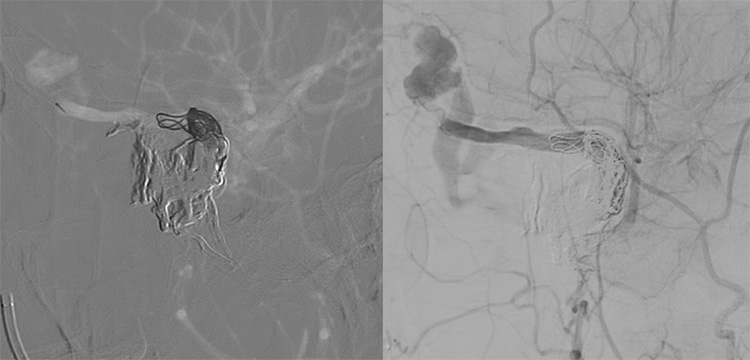 Multipouch Intraosseous DAVF Embolisation