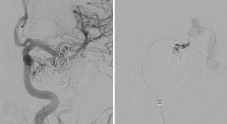 Multipouch Intraosseous DAVF Embolisation